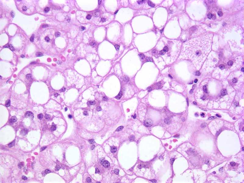 Fatty Liver slide 2