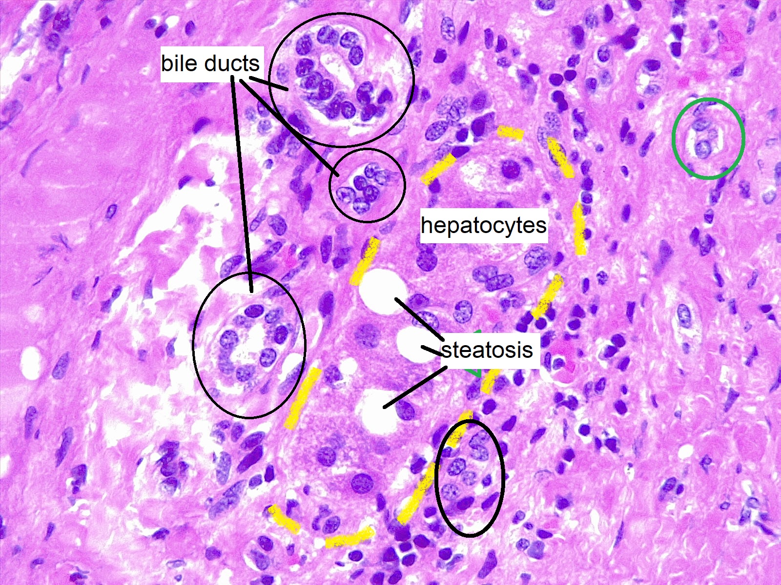 Fatty Liver slide 1