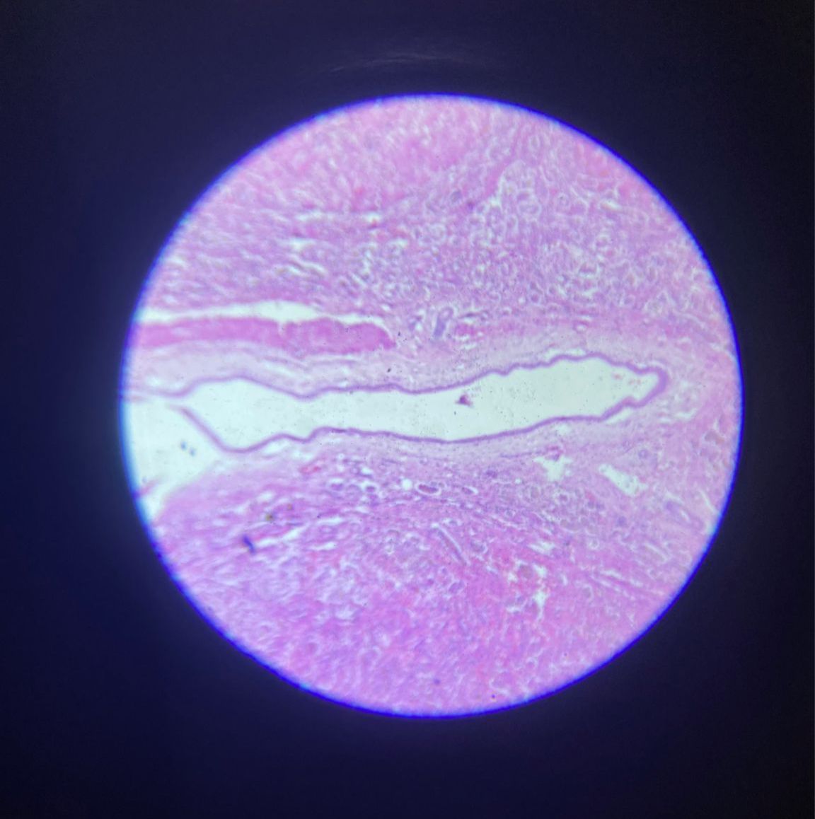 Fatty Liver