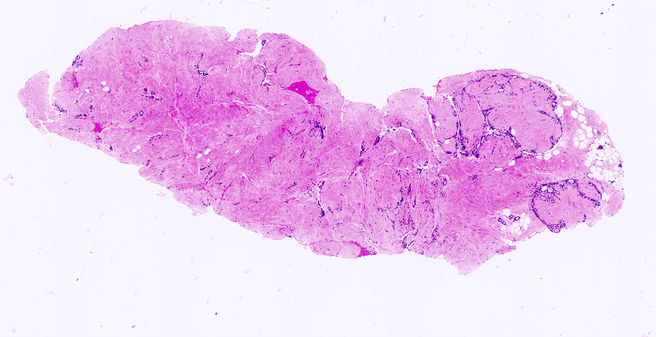 Fibroadenoma slide 2