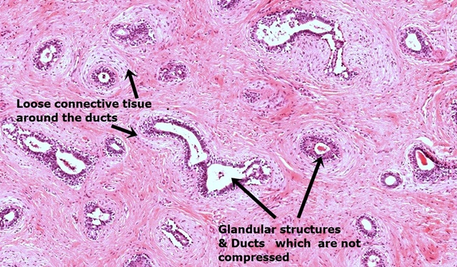 Fibroadenoma slide 1