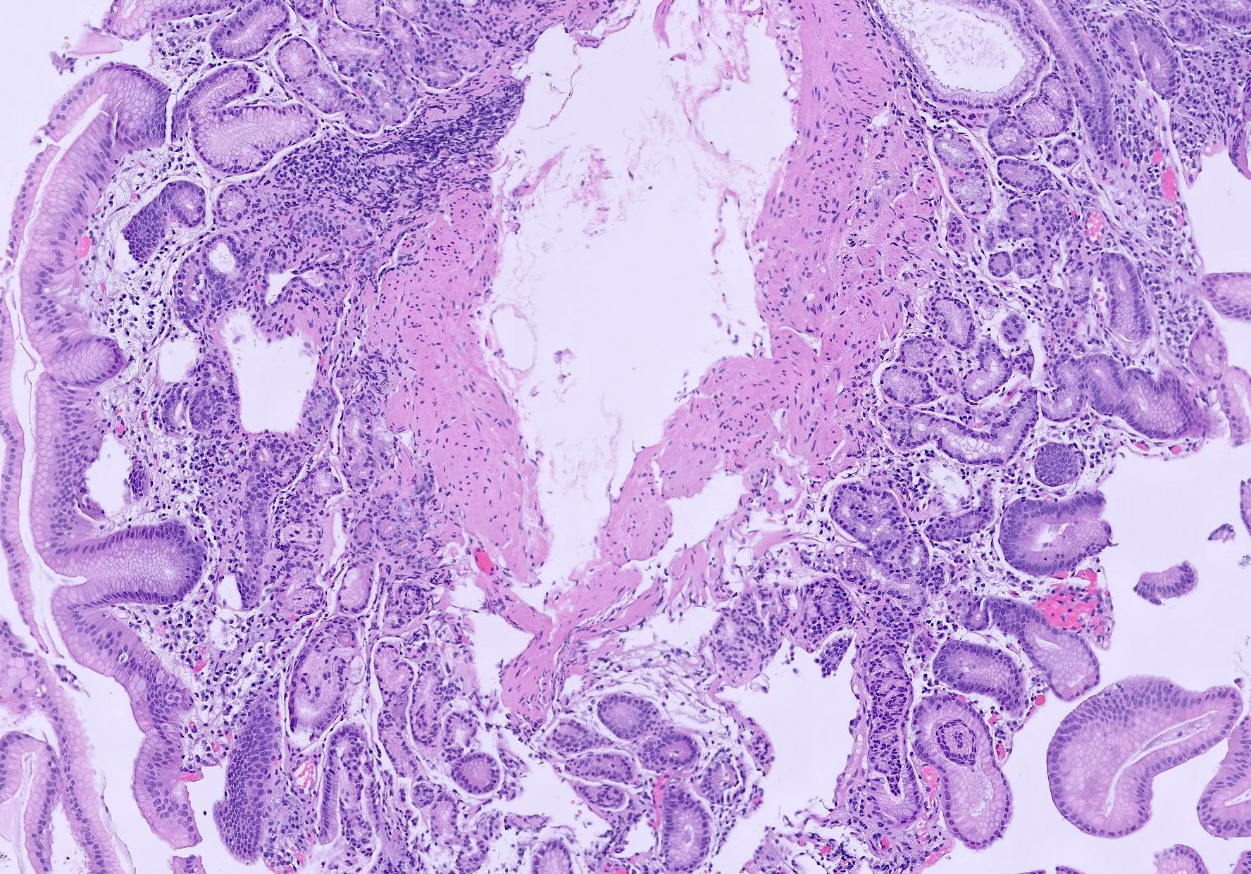 Gastritis slide 2