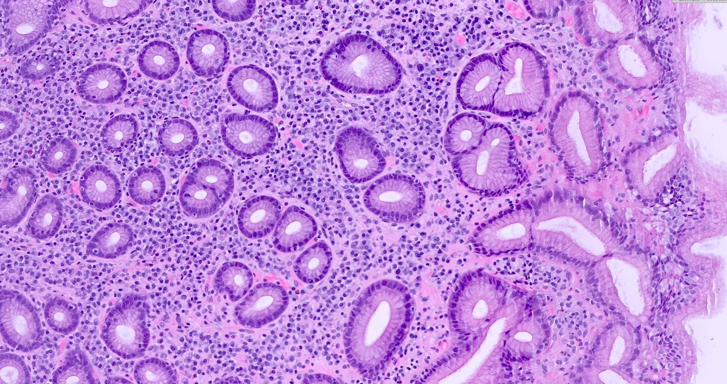 Gastritis