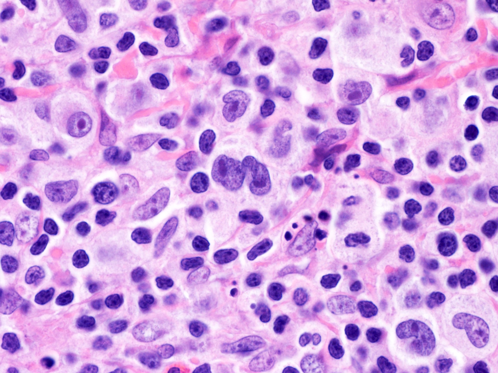 Hodgkin's Disease
