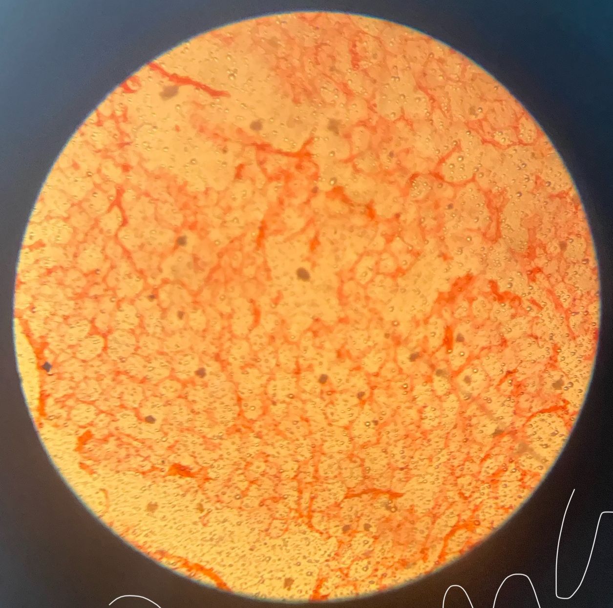 Lipoma