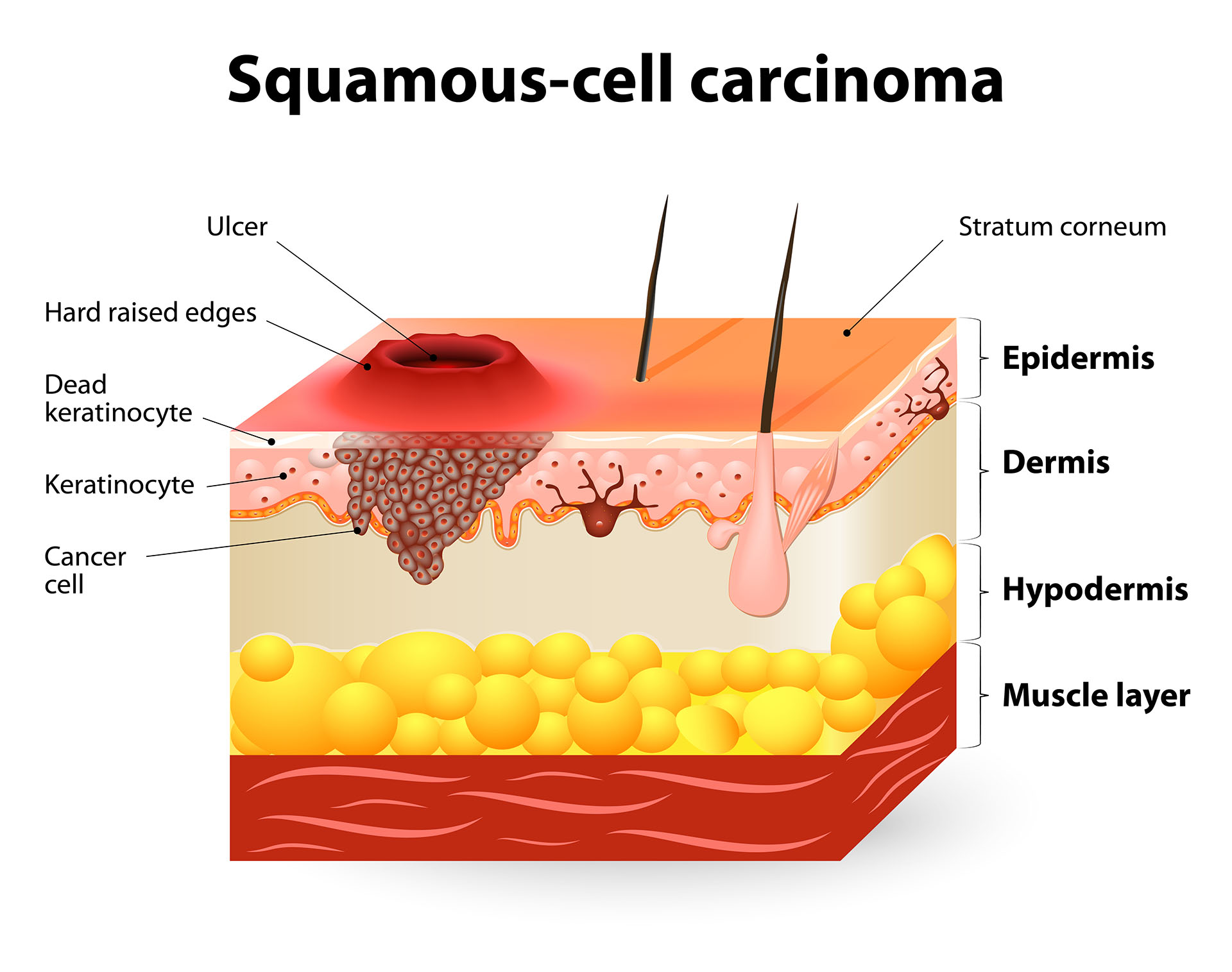 Squamous Cell Carcinoma slide 1